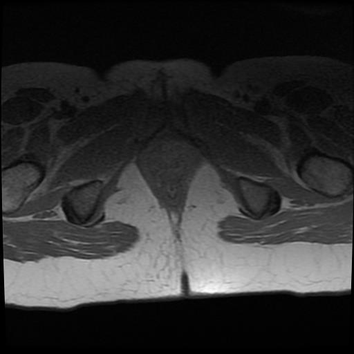 File:Cervical cancer (Radiopaedia 62991-71413 Axial T1 19).jpg