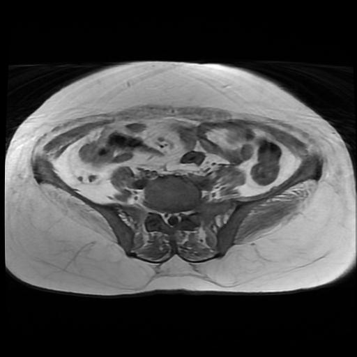 File:Cervical carcinoma (Radiopaedia 88010-104555 Axial T1 2).jpg