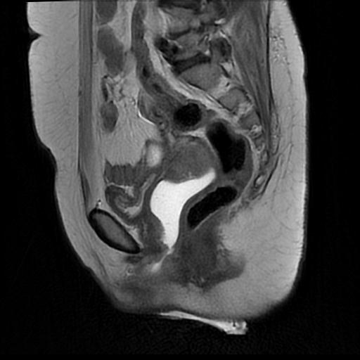 File:Cervical carcinoma (Radiopaedia 88010-104555 Sagittal T2 12).jpg