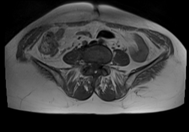 File:Cervical carcinoma (Radiopaedia 88312-104943 Axial T1 1).jpg