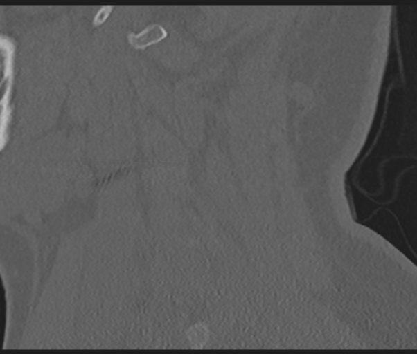 File:Cervical disc replacement (Radiopaedia 44025-47541 Sagittal bone window 18).png
