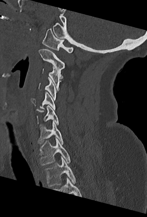 Cervical spine ACDF loosening (Radiopaedia 48998-54070 Sagittal bone window 55).png