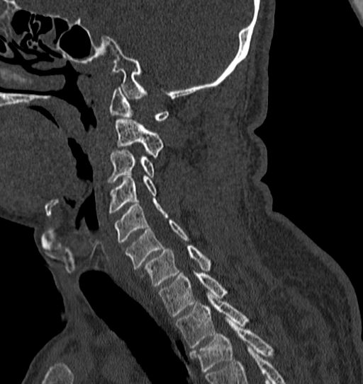 Cervical spine trauma with tear drop fracture and perched facet joint (Radiopaedia 53989-60127 Sagittal bone window 58).jpg