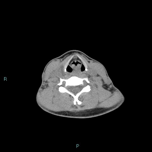 Cervical thymic cyst (Radiopaedia 88632-105335 Axial non-contrast 53).jpg