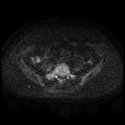 Cesarian section scar endometriosis (Radiopaedia 66520-75799 Axial DWI 51).jpg