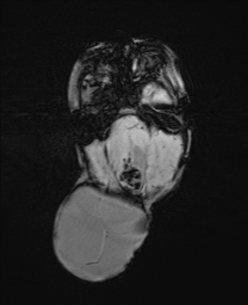 Chiari III malformation with occipital encephalocele (Radiopaedia 79446-92559 Axial SWI 27).jpg