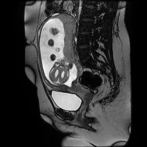 Chiari II malformation - fetal MRI (Radiopaedia 68099-77581 Sagittal Fiesta 27).jpg