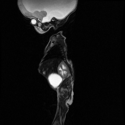 File:Chiari II malformation with spinal meningomyelocele (Radiopaedia 23550-23652 Sagittal T2 11).jpg