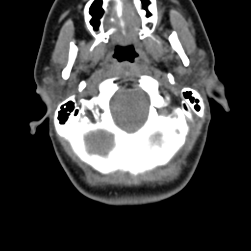 Chiari I malformation and obstructive hydrocephalus (Radiopaedia 41185-43981 D 31).png