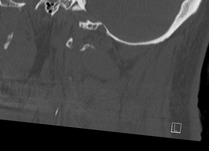 Chiari I malformation with a symptomatic syrinx of the posterolateral medulla oblongata (Radiopaedia 42573-45707 A 45).jpg