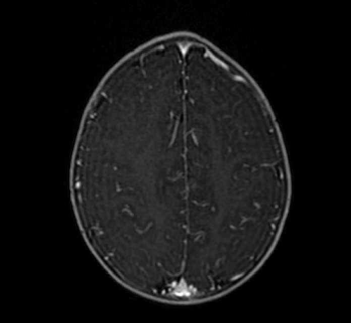 Chiasmatic-hypothalamic glioma (Radiopaedia 90079-107252 Axial T1 C+ 70).jpg