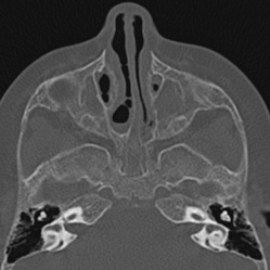 Choanal atresia (Radiopaedia 88525-105975 Axial bone window 41).jpg