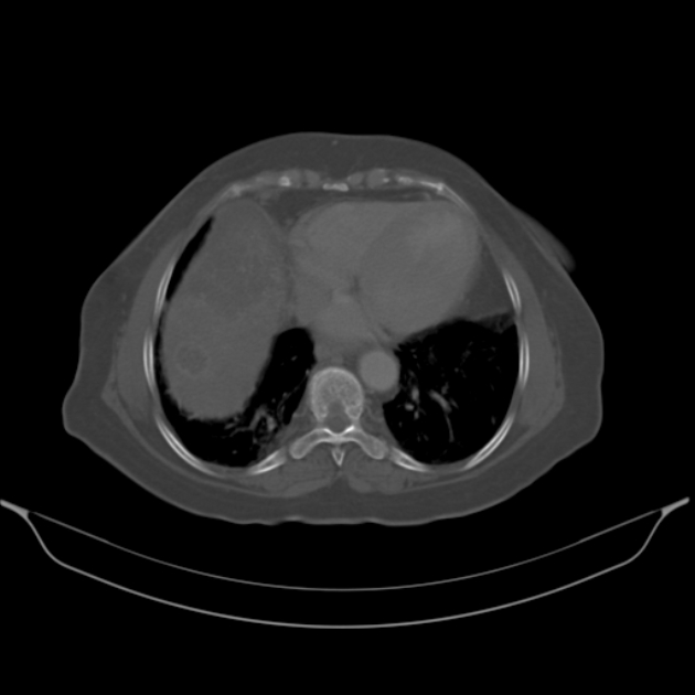 Cholangiocarcinoma (Radiopaedia 50592-56025 Axial bone window 6).jpg