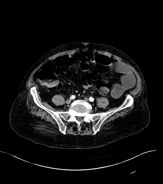 Cholangiocarcinoma with cerebral metastases (Radiopaedia 83519-98629 B 86).jpg