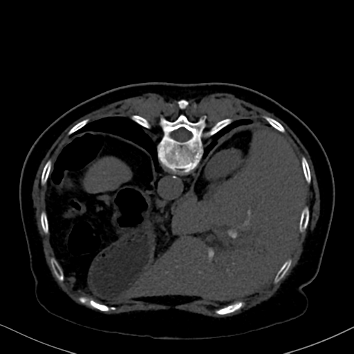 File:Cholecystitis - obstructive choledocholitiasis (CT intravenous cholangiography) (Radiopaedia 43966-47479 Axial 21).png