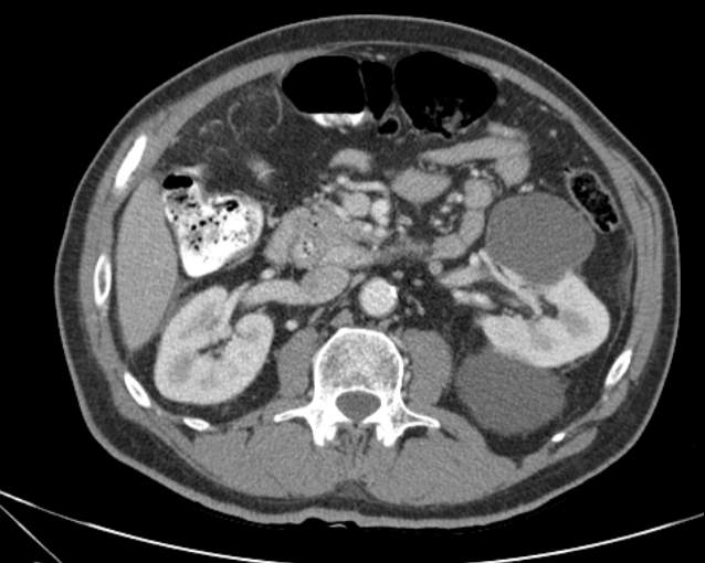 Cholecystitis - perforated gallbladder (Radiopaedia 57038-63916 A 38).jpg