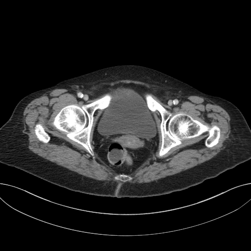 Cholecystoduodenal fistula due to calculous cholecystitis with gallstone migration (Radiopaedia 86875-103077 D 77).jpg