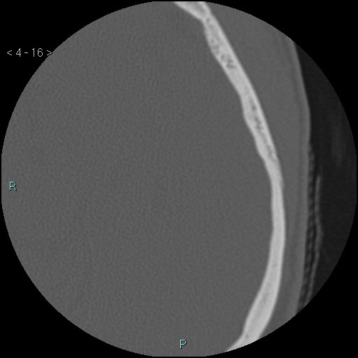 File:Cholesterol granuloma of the petrous apex (Radiopaedia 64358-73141 Axial bone window 8).jpg