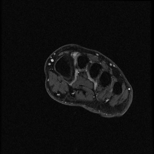 File:Chondroblastoma - midfoot (Radiopaedia 64831-73765 G 21).jpg