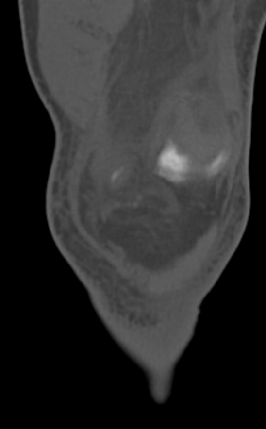 Chondrocalcinosis (Radiopaedia 82862-97173 Coronal bone window 18).jpg