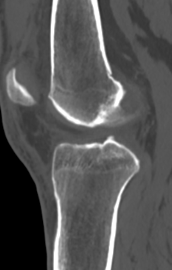Chondrocalcinosis (Radiopaedia 82862-97173 Sagittal bone window 34).jpg