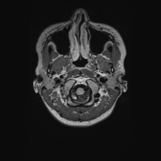 Chondrosarcoma (Radiopaedia 41937-44939 Axial FLAIR 9).png