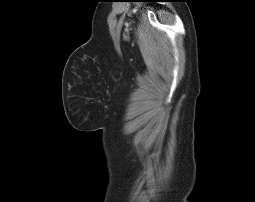 Chondrosarcoma - chest wall (Radiopaedia 65192-74199 B 6).jpg
