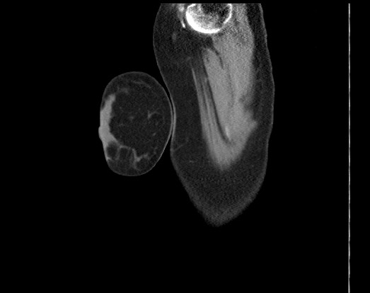 Chondrosarcoma - chest wall (Radiopaedia 65192-74199 B 60).jpg