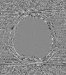 Chondrosarcoma - sphenoid wing (Radiopaedia 58259-67947 Axial SWI 59).jpg