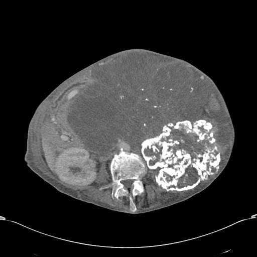Chondrosarcoma of the spine (Radiopaedia 49871-55143 A 33).jpg