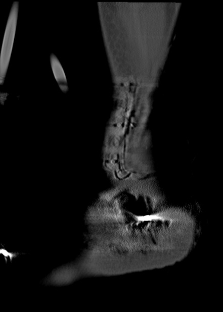 Chopart fracture (Radiopaedia 35347-36861 Sagittal bone window 63).jpg