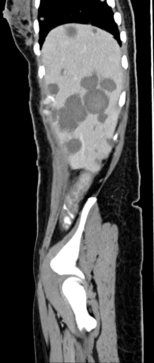 Choriocarcinoma liver metastases (Radiopaedia 74768-85766 C 144).jpg