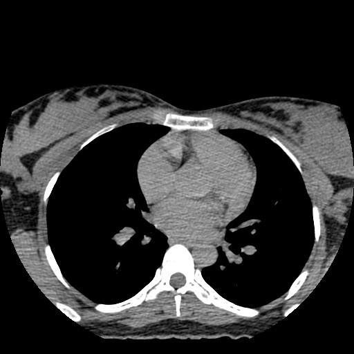 File:Choriocarcinoma of ovary with cerebral and pulmonary metastases (Radiopaedia 25983-26119 Axial non-contrast 142).jpg