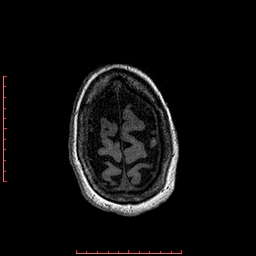 Choroid plexus xanthogranuloma (Radiopaedia 67843-77270 Axial T1 29).jpg