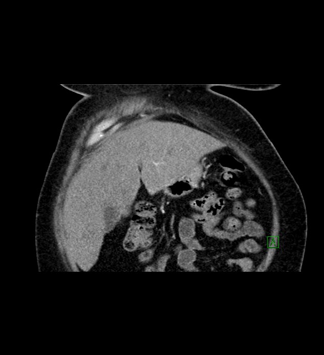 Chromophobe renal cell carcinoma (Radiopaedia 84239-99519 C 19).jpg