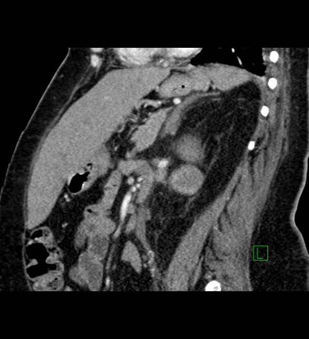 Chromophobe renal cell carcinoma (Radiopaedia 84239-99519 D 50).jpg