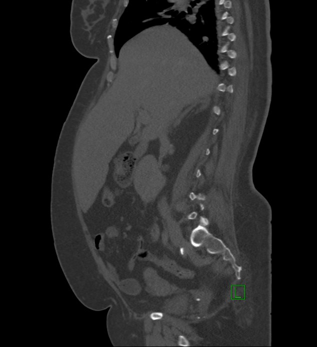 Chromophobe renal cell carcinoma (Radiopaedia 84239-99519 Sagittal bone window 67).jpg