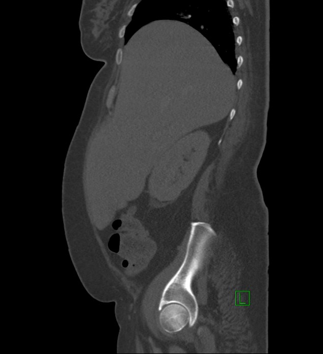 Chromophobe renal cell carcinoma (Radiopaedia 84239-99519 Sagittal bone window 82).jpg