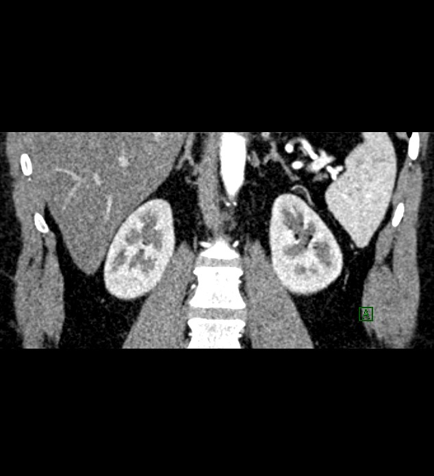 Chromophobe renal cell carcinoma (Radiopaedia 84286-99573 E 57).jpg