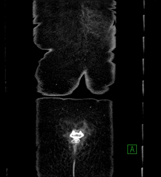 Chromophobe renal cell carcinoma (Radiopaedia 84290-99582 F 70).jpg