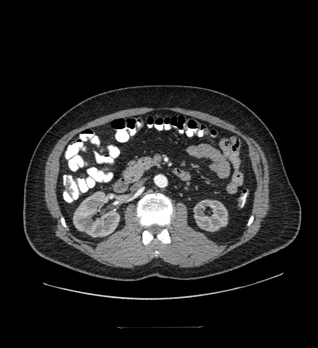 Chromophobe renal cell carcinoma (Radiopaedia 84337-99644 B 45).jpg