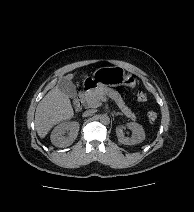 Chromophobe renal cell carcinoma (Radiopaedia 84337-99693 Axial non-contrast 43).jpg