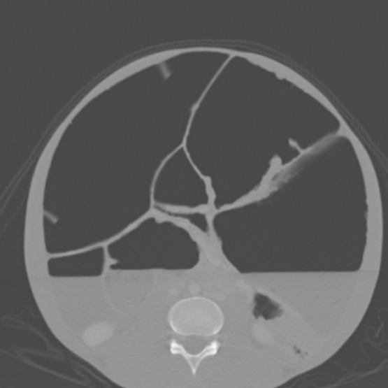 File:Chronic large bowel pseudo-obstruction (Radiopaedia 43181-46492 Axial bone window 102).jpg