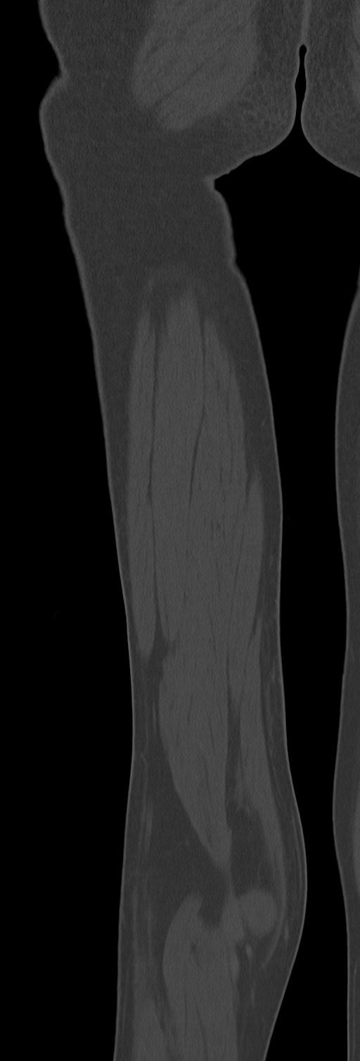 Chronic ostemyelitis of the femur with long sinus tract (Radiopaedia 74947-85982 Coronal bone window 69).jpg