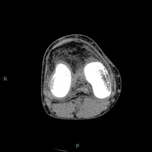 Chronic osteomyelitis (with Brodie abscess) (Radiopaedia 76405-88111 A 116).jpg