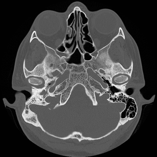File:Chronic otomastoiditis (Radiopaedia 27138-27309 Axial bone window 22).jpg