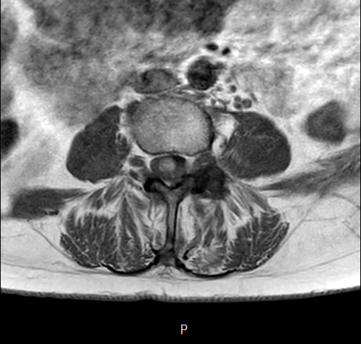 File:Chronic spinal hematoma with cauda equina syndrome (Radiopaedia 75745-87090 Axial T1 18).png
