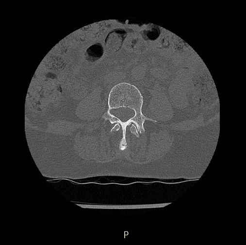 Chronic spinal hematoma with cauda equina syndrome (Radiopaedia 75745-88197 Axial bone window 24).png