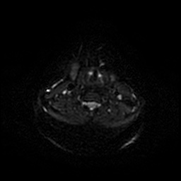 Chronic submandibular sialadenitis (Radiopaedia 61852-69885 Axial DWI 49).jpg