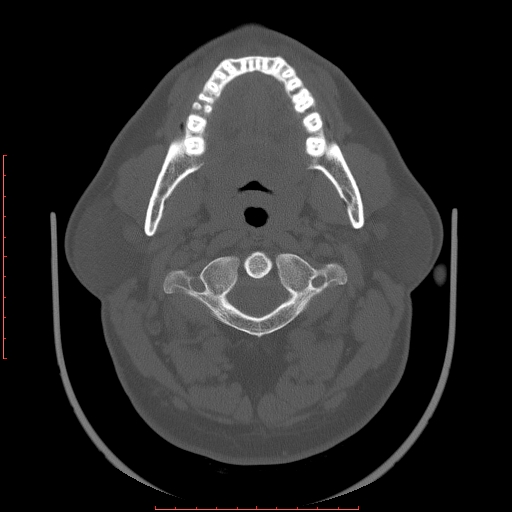 Chronic submandibular sialolithiasis (Radiopaedia 69817-79814 Axial bone window 38).jpg